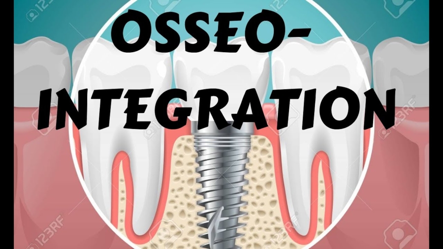 Osseo Integration