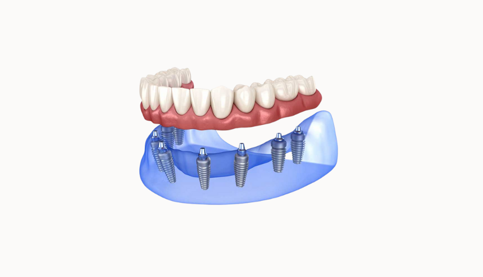 full arch implant prosthesis